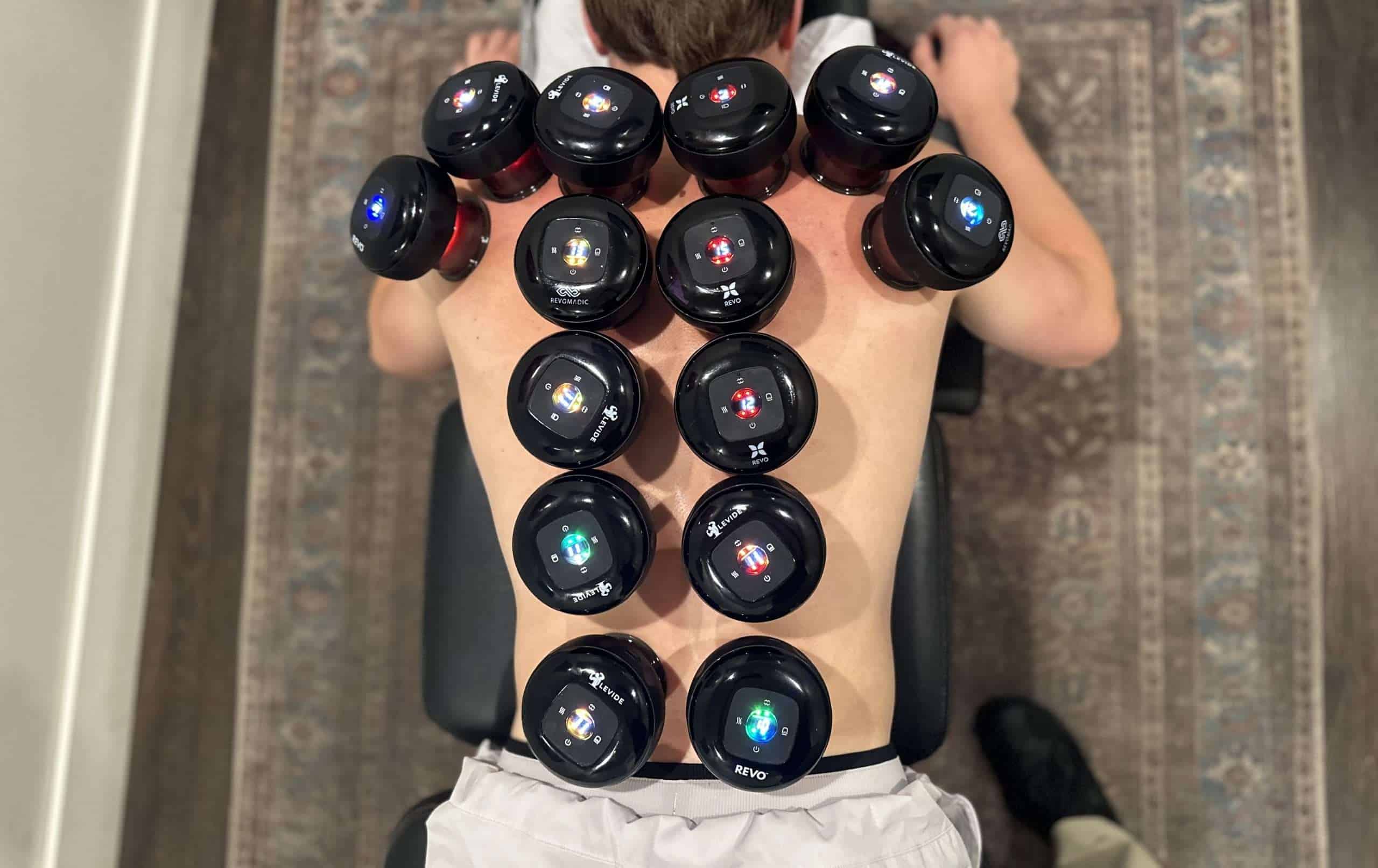 Cupping therapy at McAlpine Chiropractic in Holland, MI
